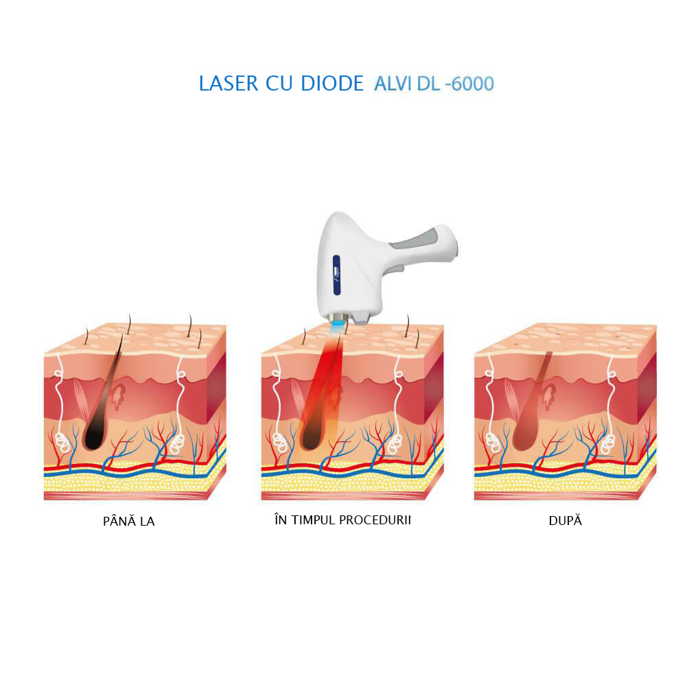 Laser cu diode DL-6000 OptiPuls Pro AlviPrague