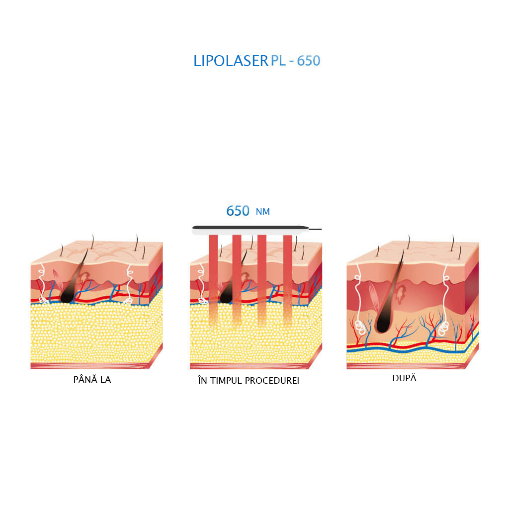 Lipolaser PL-650 Alvi-Prague