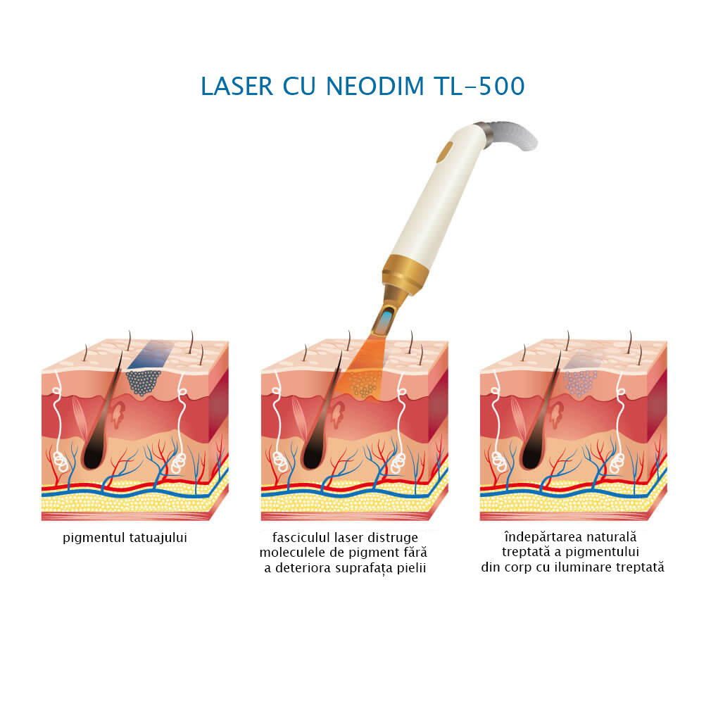 îndepărtarea cu laser a tatuajelor TL-500 ND Yag Alvi=Prague
