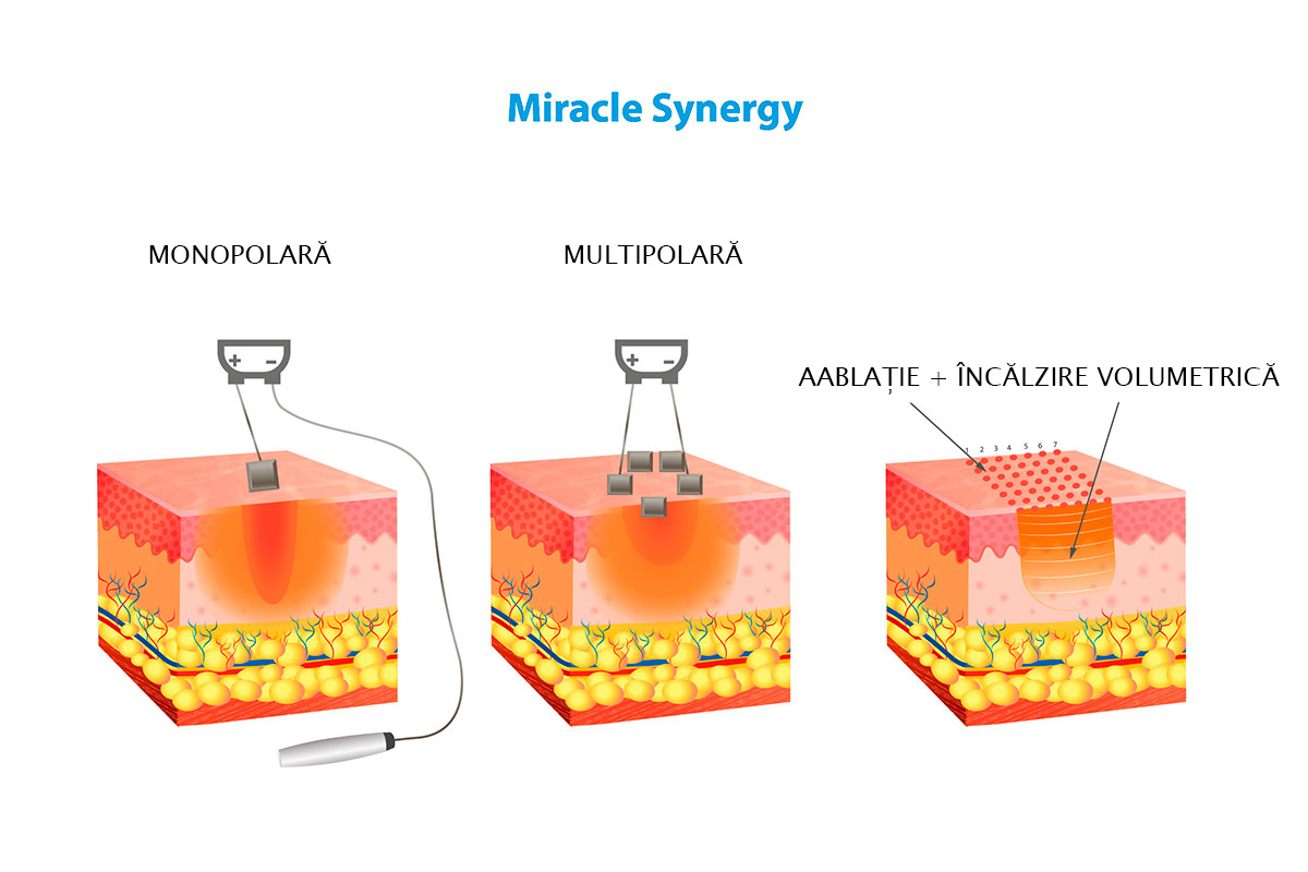 rf-lifting fractionat miracle synergy Alvi-Prague