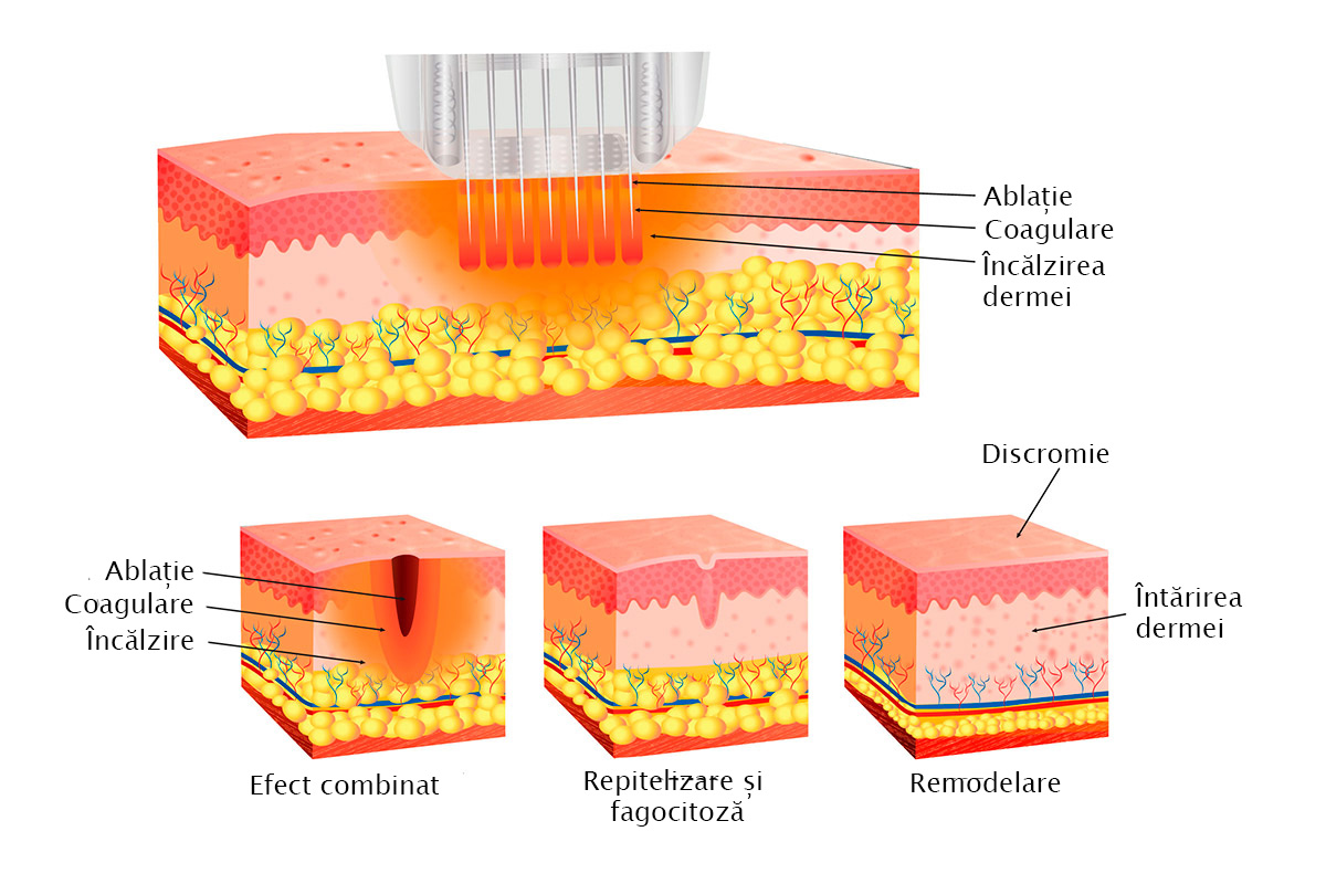 rf-lifting fractionat miracle synergy Alvi-Prague