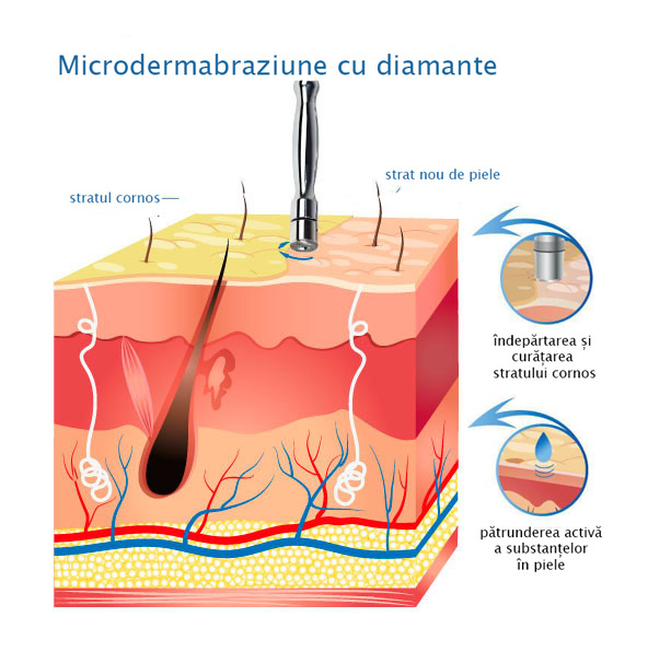 peeling cu diamante microdermbraziune combina cosmetologica