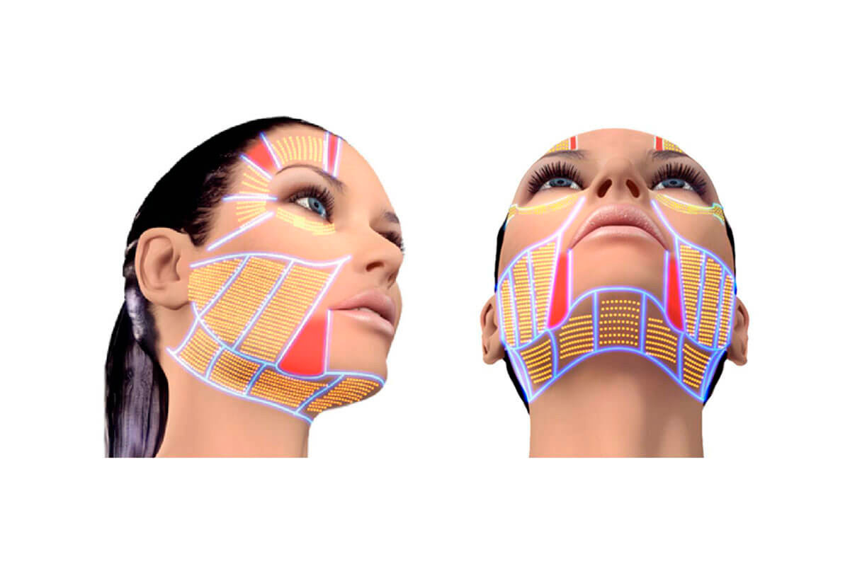 HIFU SMAS lifting AlviPrague