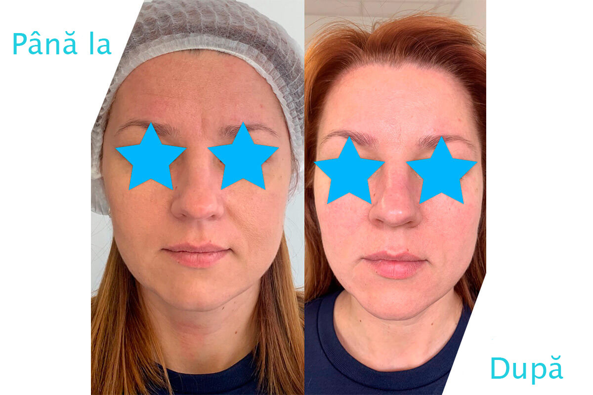 HIFU SMAS lifting AlviPrague